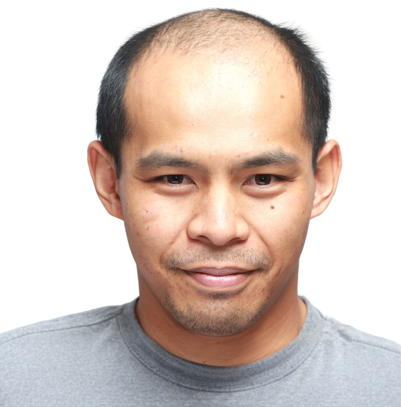 Ron C. before his hair transplant, showing thinning on top