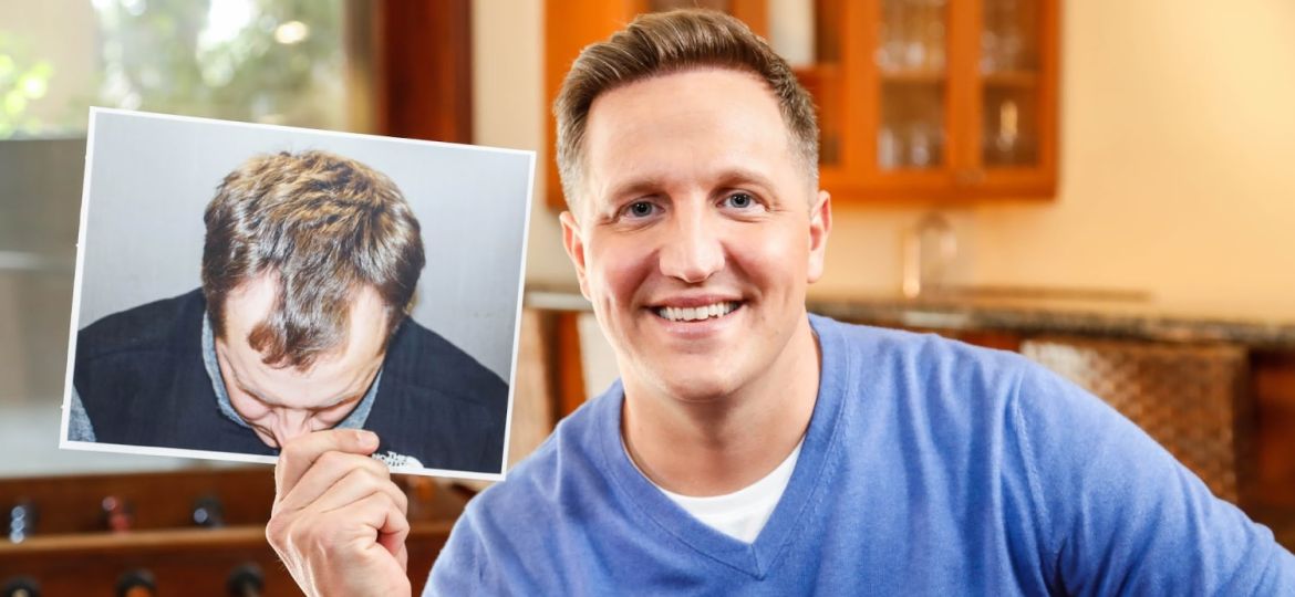 Hair-Transplant-Cost