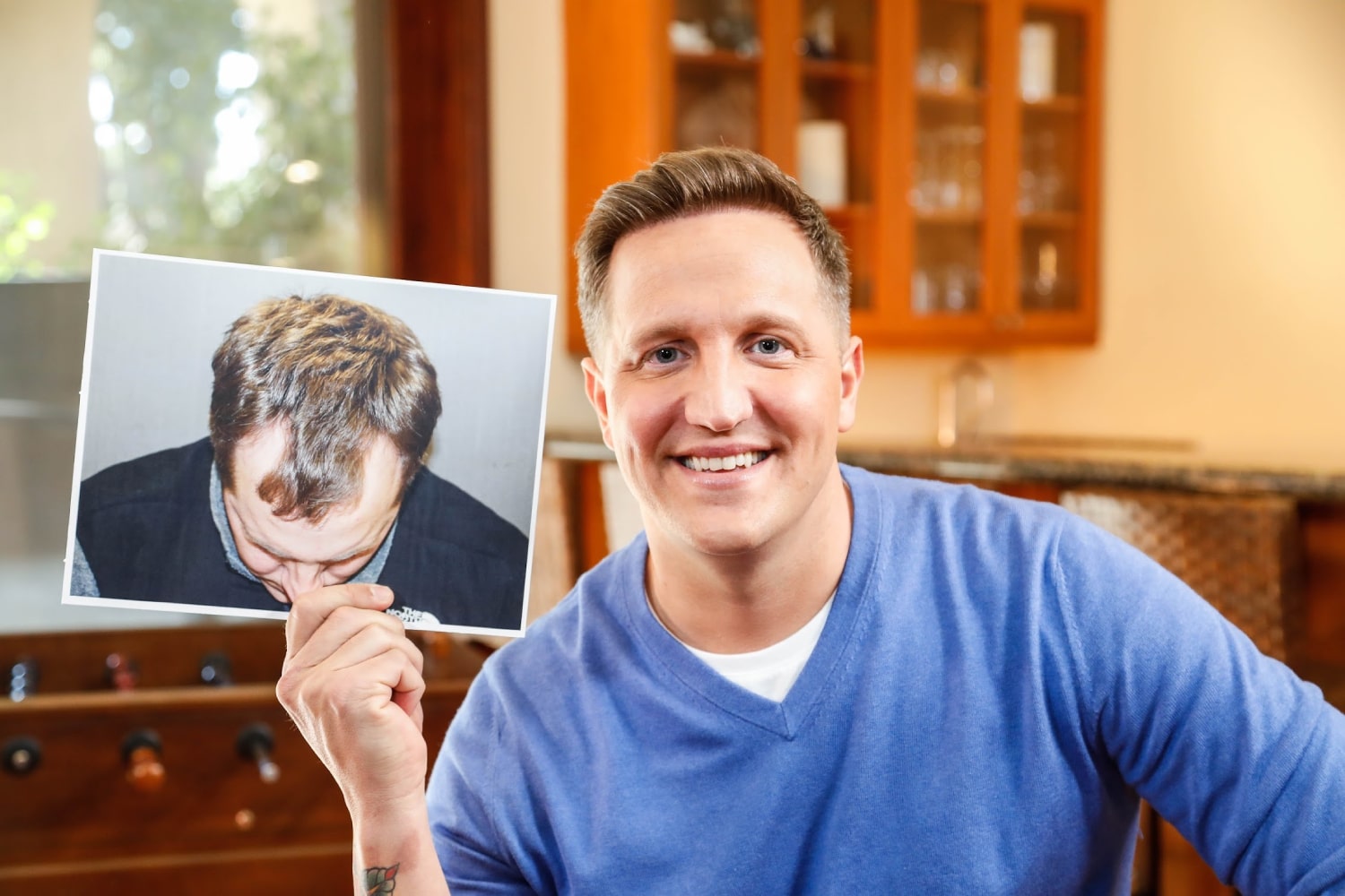 Hair-Transplant-Cost