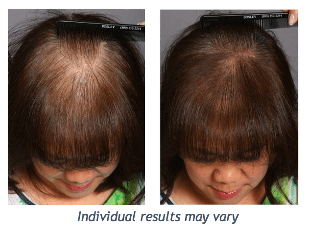 Before and after photo of a female Scalp Micropigmentation patient