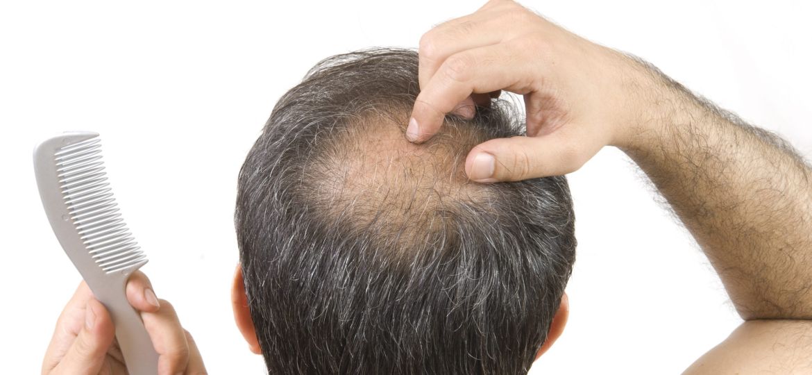 man itching his bald spot while holding a comb