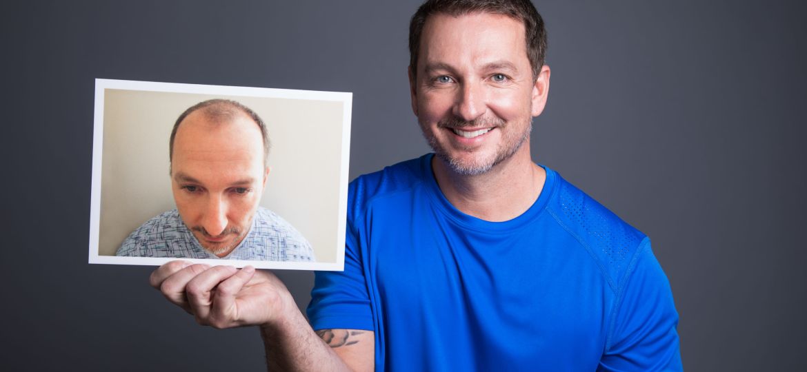 Man holding before/after picture of hair transplant results