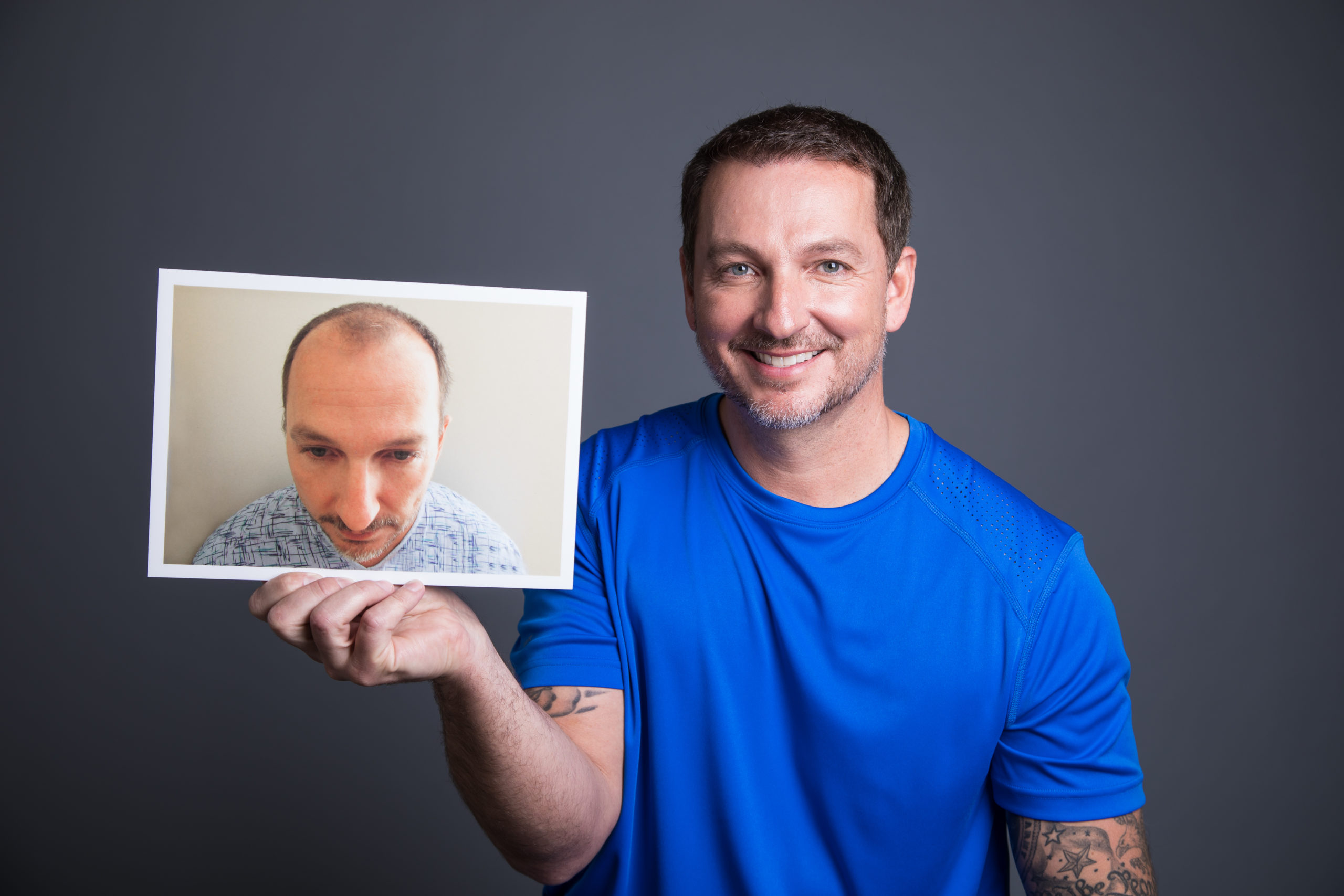 Man holding before/after picture of hair transplant results