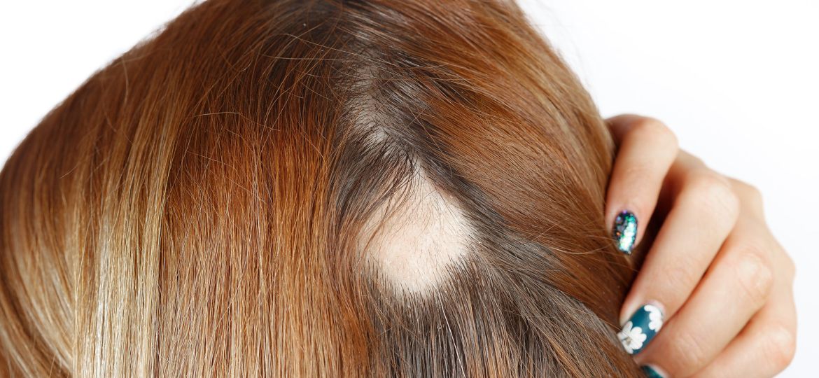 woman with alopecia bald spot
