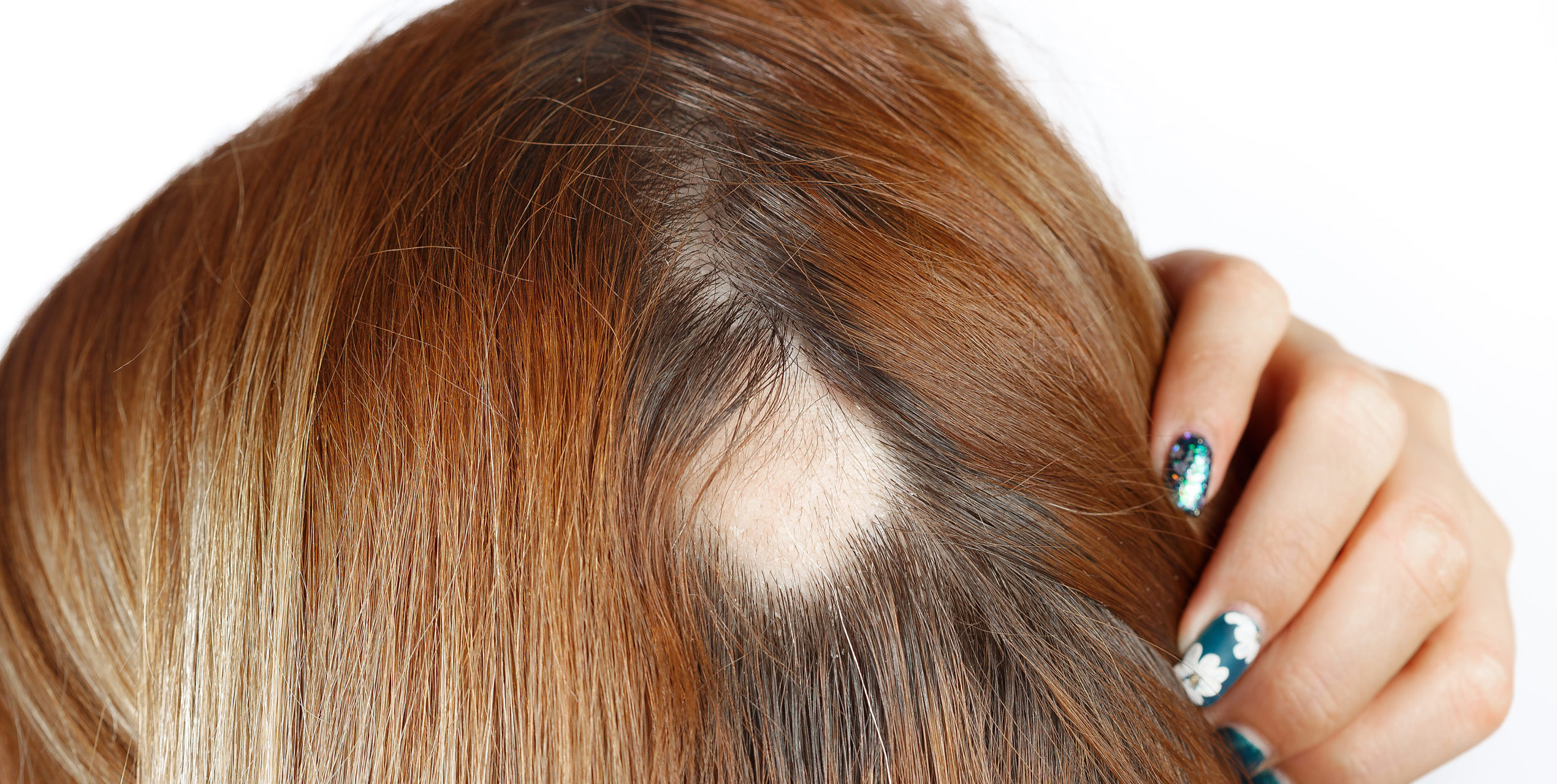 woman with alopecia bald spot