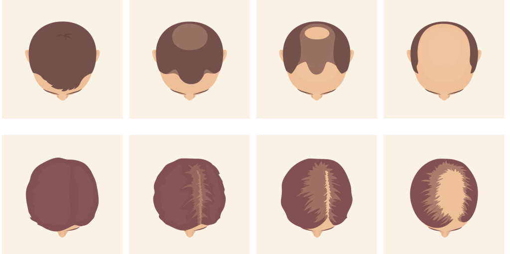illustrations of male and female pattern baldness