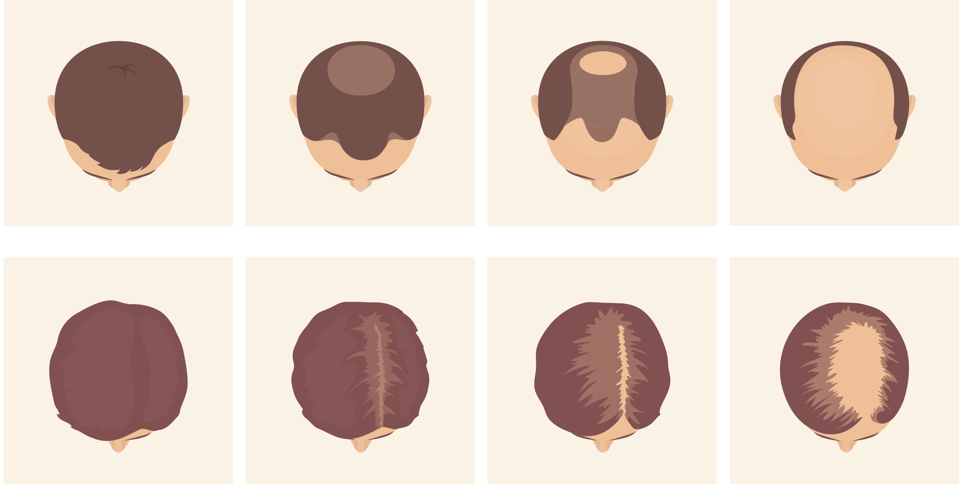 illustrations of male and female pattern baldness