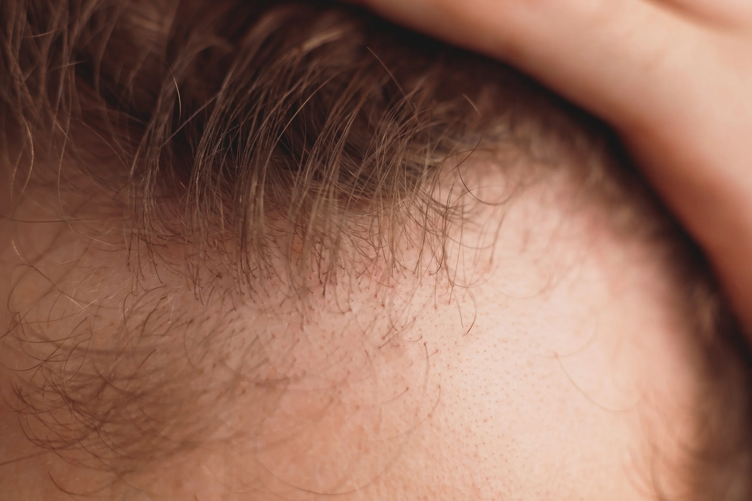 Can You Prevent Hair Loss