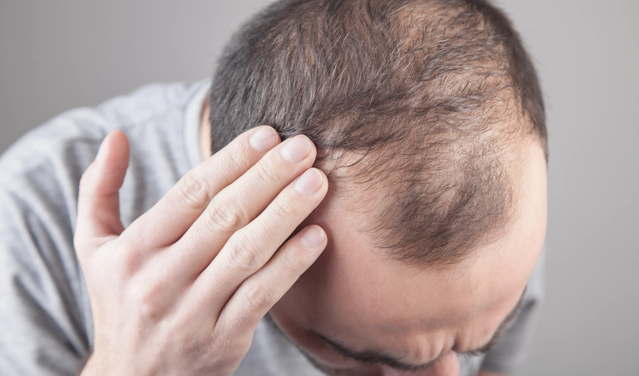 Will Minoxidil Help Regrow Hair