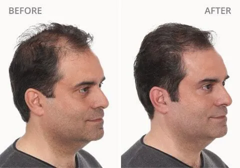 Nabil F. Before and After