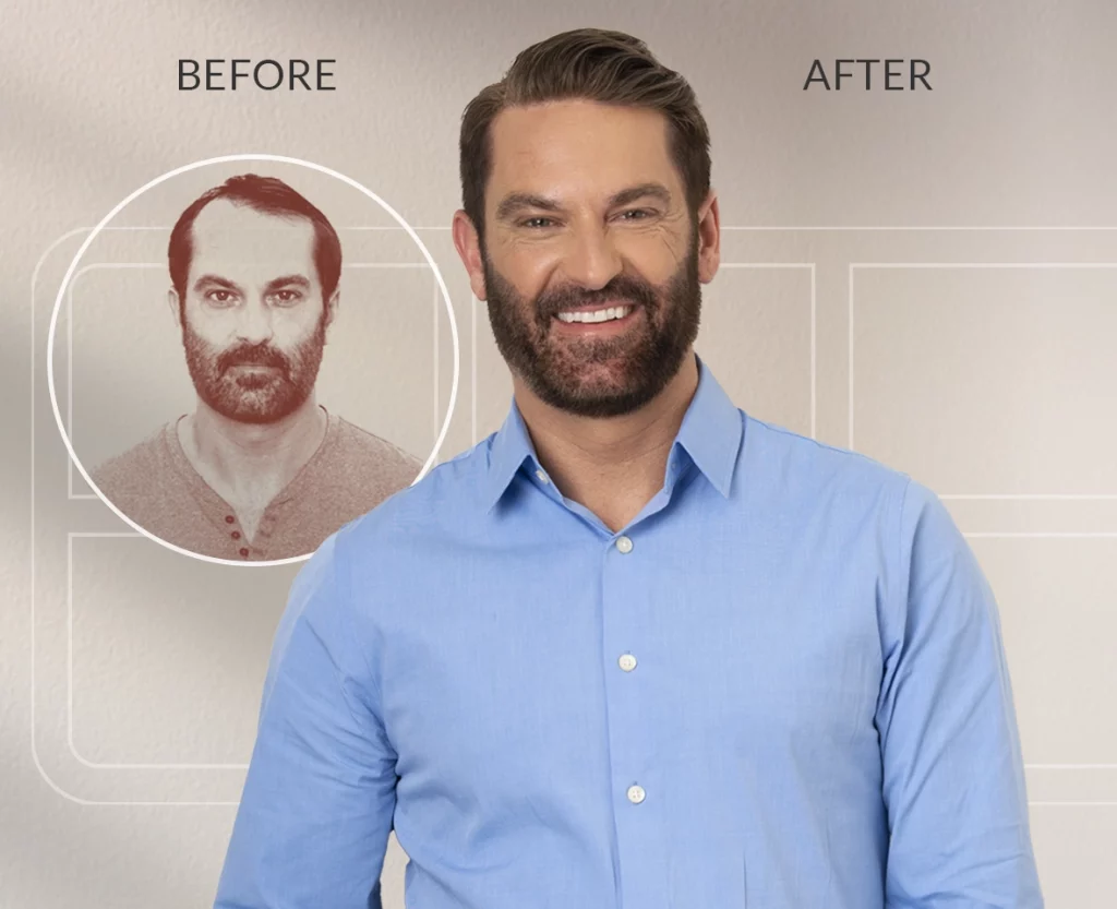 Tyler Morehead - Before and after Xtrands+