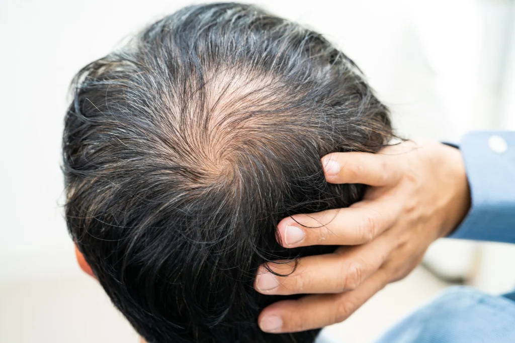 How Do You Regrow, Replace or Restore Hair