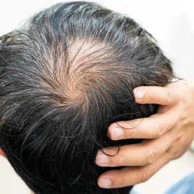 How Do You Regrow, Replace or Restore Hair