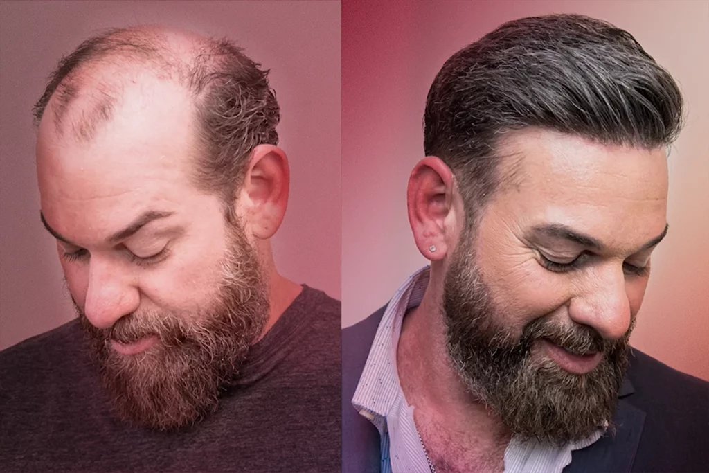 Kevin B. before and after - Xtrands+