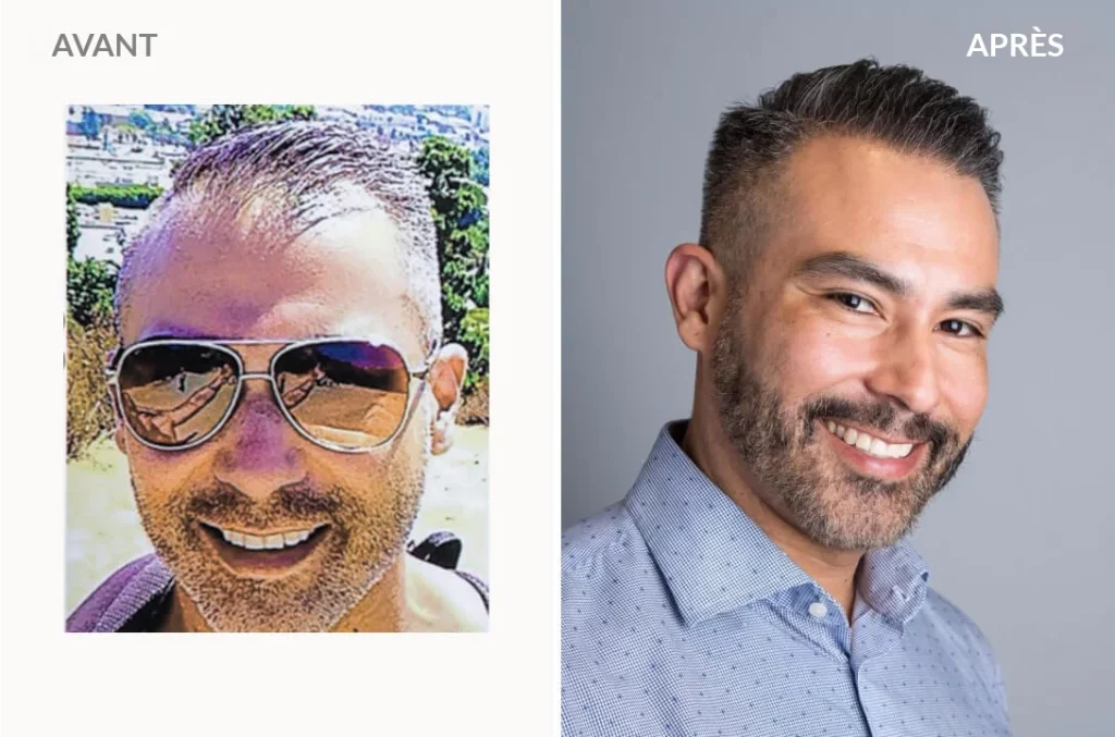 Edgar-S. - Hair Transplant