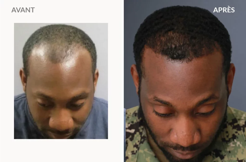 Raynard M. - Hair Transplant