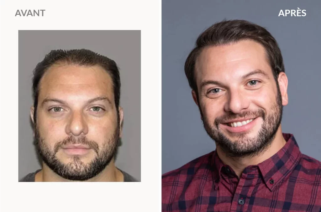 Ryan L. - Hair Transplant
