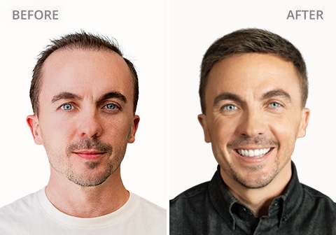 Frankie M. Before and after - Xtrands+ Client