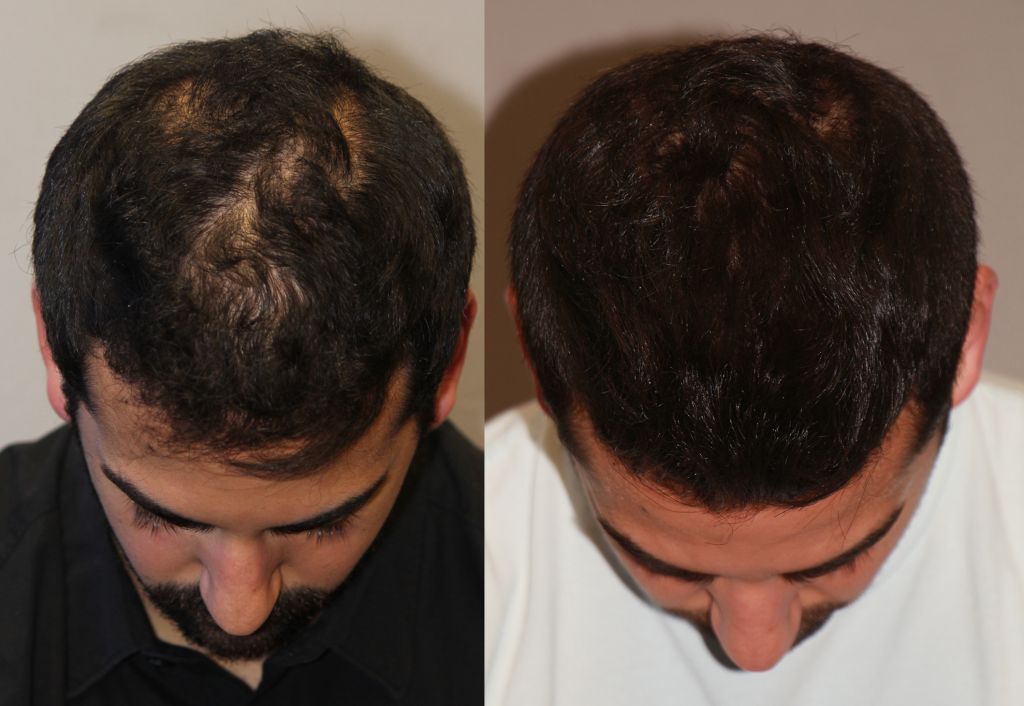 Alopecia Areata