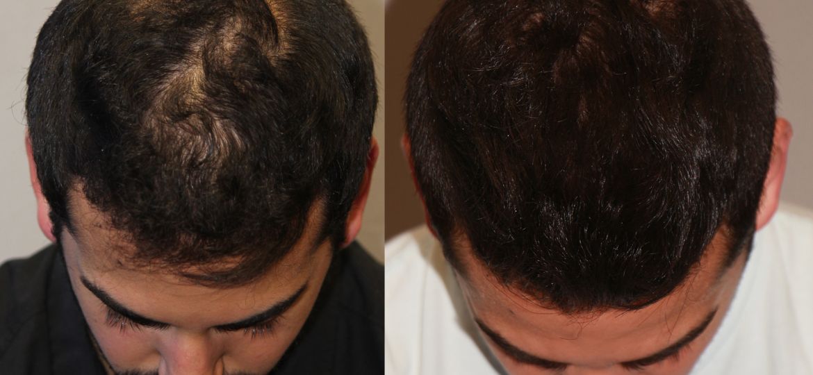 Alopecia Areata