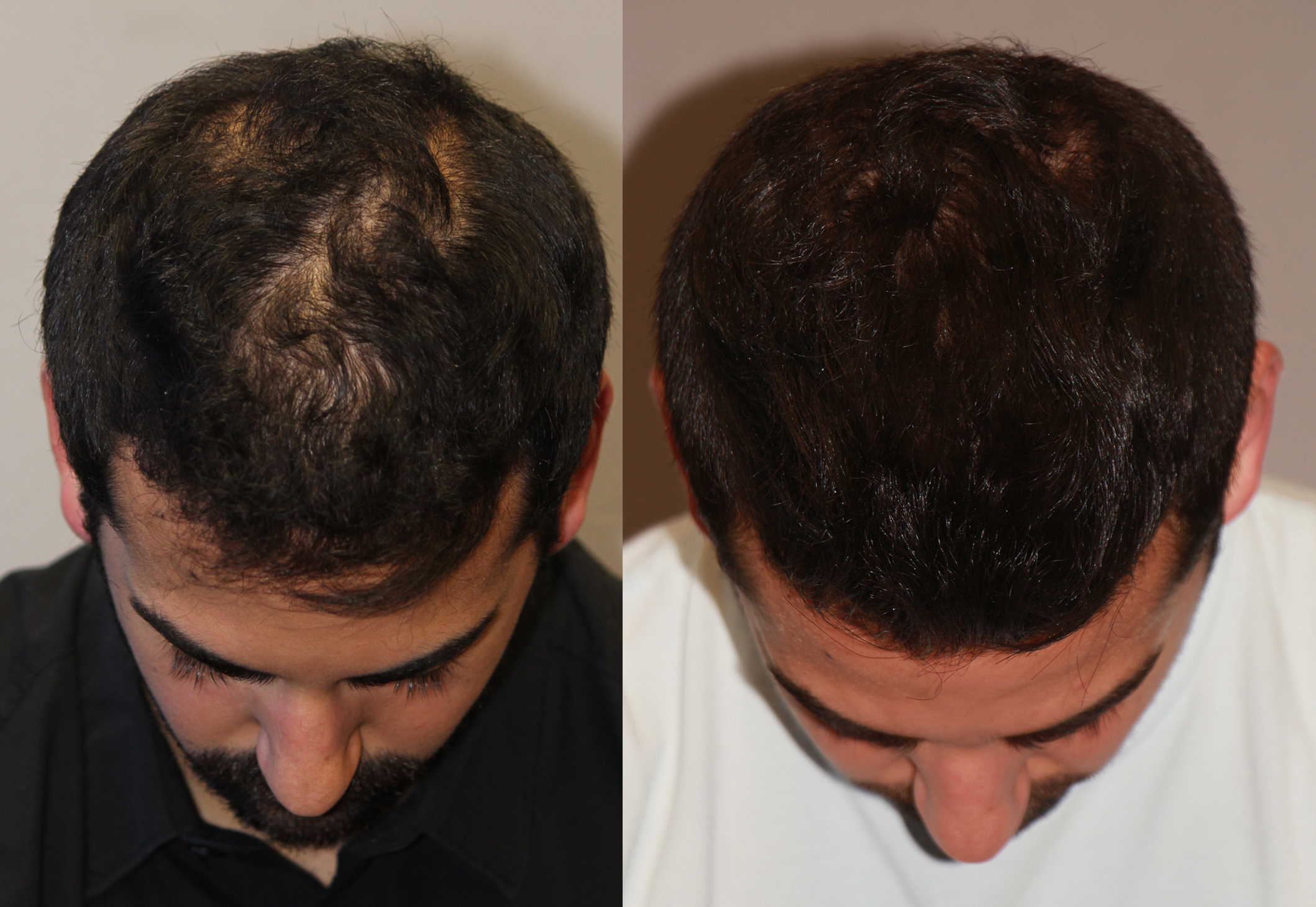 Alopecia Areata
