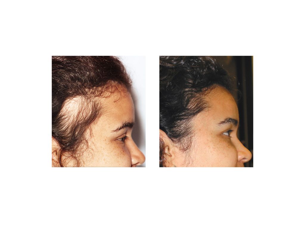 Scarring-Alopecia