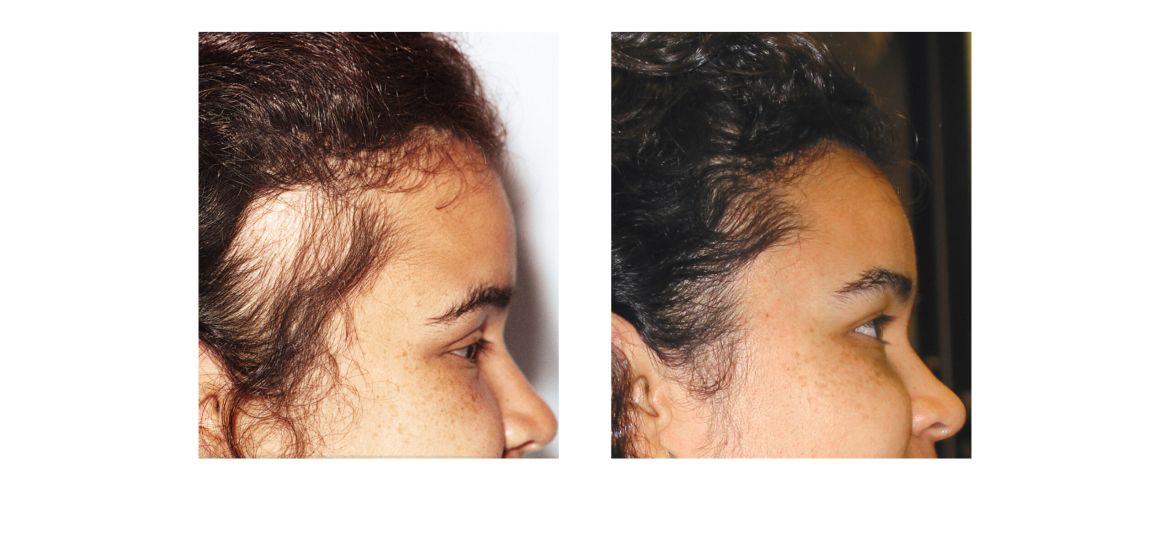 Scarring-Alopecia