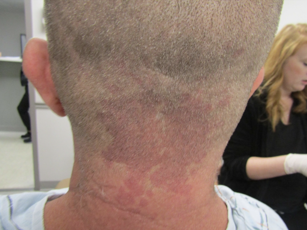 Seborrheic-Dermatitis