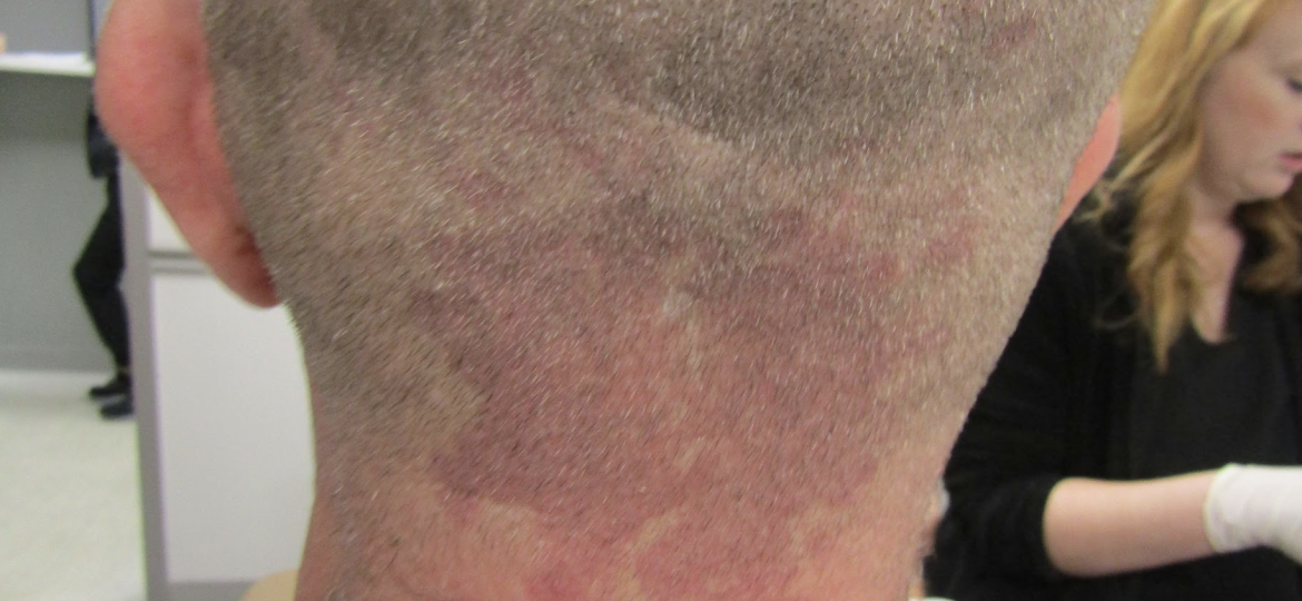 Seborrheic-Dermatitis