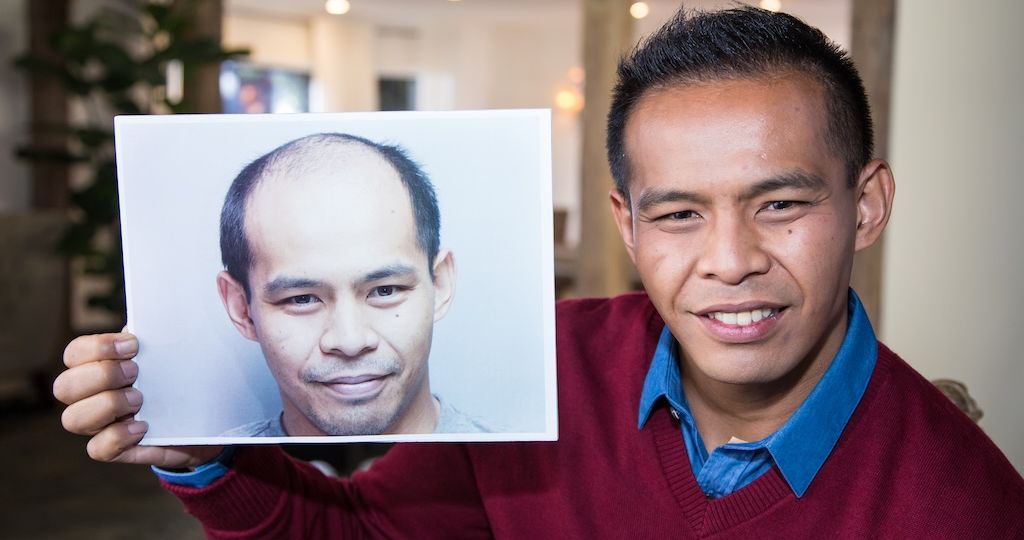 Bosley patient after holding before picture