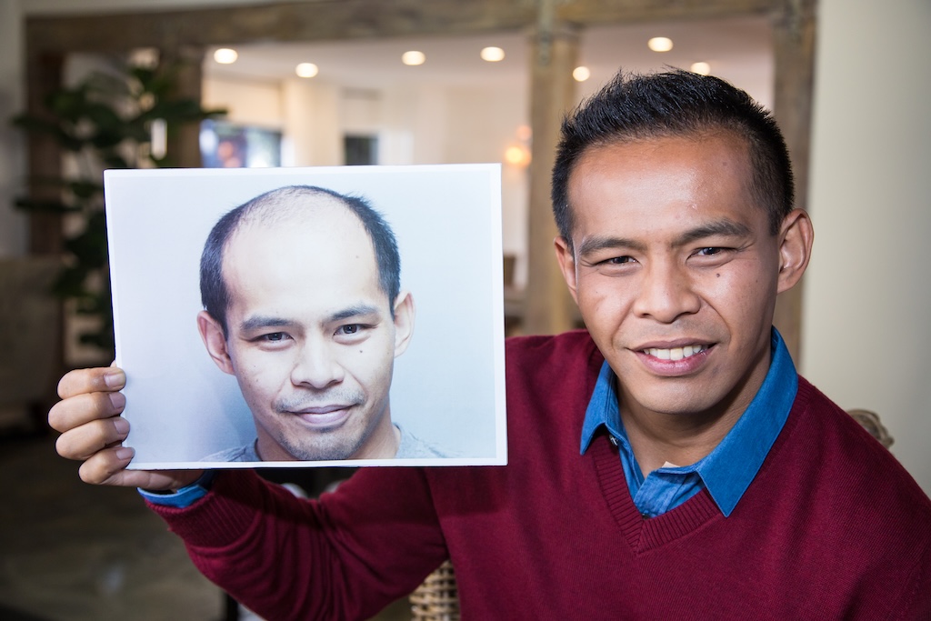 Bosley patient after holding before picture