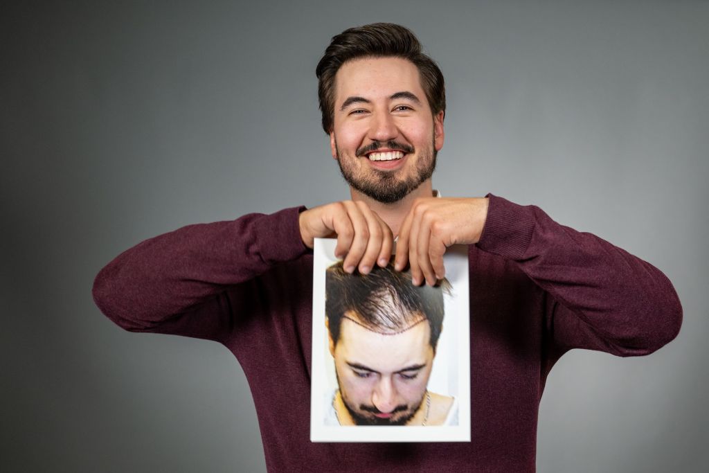 hair-growth-for-men
