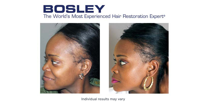 hair-restoration-near-me-3