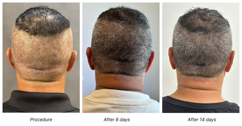 shave-free-fue