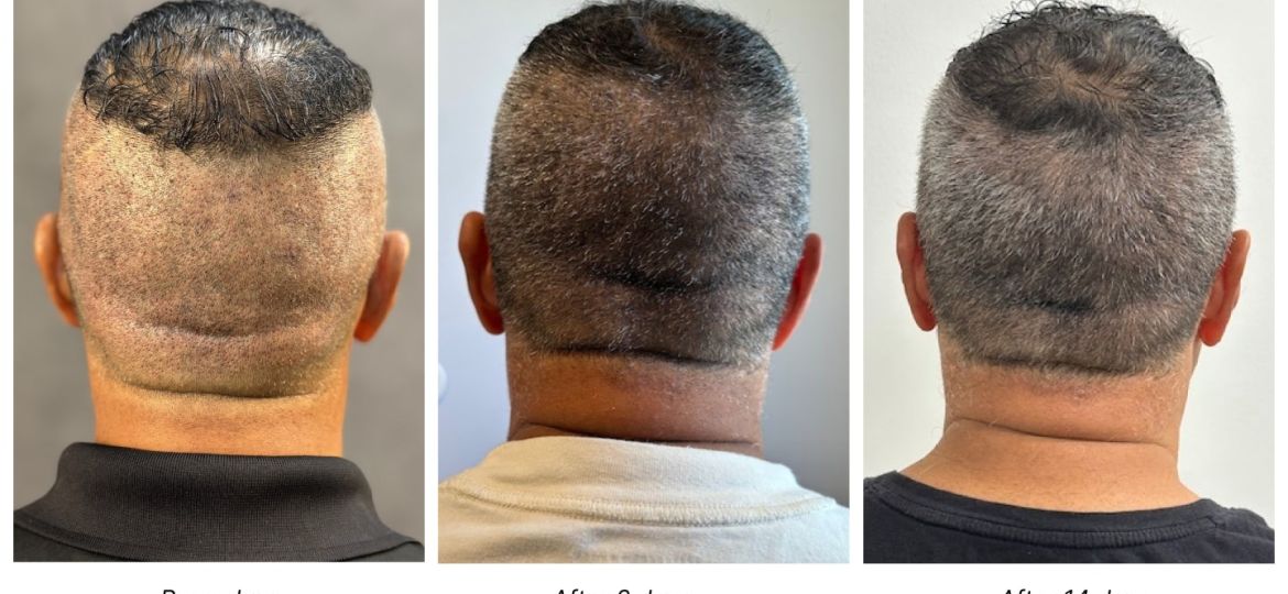 shave-free-fue