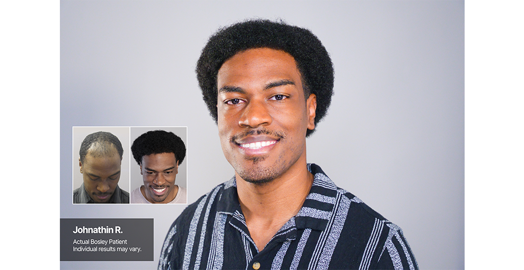 Johnathin Lifestyle-B&A