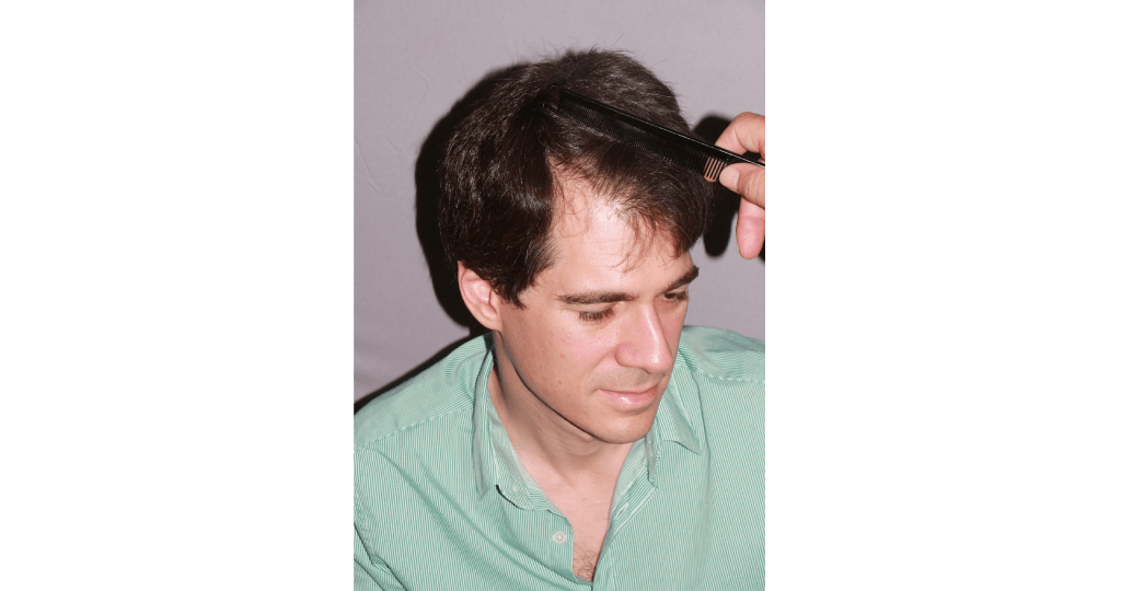 best-hair-loss-treatment-for-men