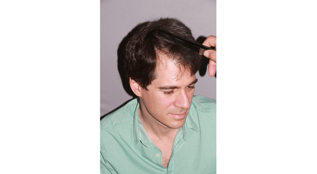 best-hair-loss-treatment-for-men