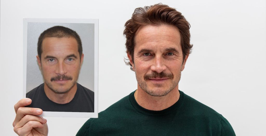 turkey-vs-usa-hair-transplant-comparison
