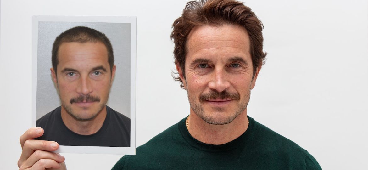 turkey-vs-usa-hair-transplant-comparison