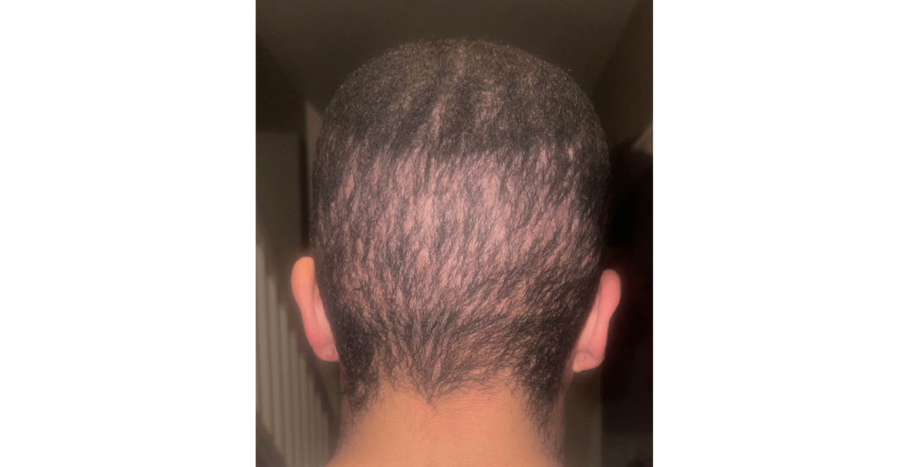 Back view of scalp showing uneven hair density and visible thinning at the crown, illustrating results of a Bad Hair Transplant with patchy growth and poor coverage.