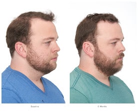 Minoxidil-for-hair-growth-results 3