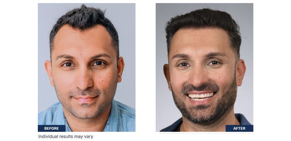 Before and after results showing visible hair regrowth and improved hairline after the Best Treatment for Hair Fall for Men, highlighting fuller, denser hair and restored confidence.