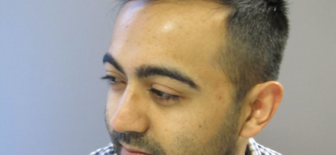 Man showing visible signs of Hair Thinning Alopecia along the hairline and temples, illustrating early-stage thinning and reduced hair density.