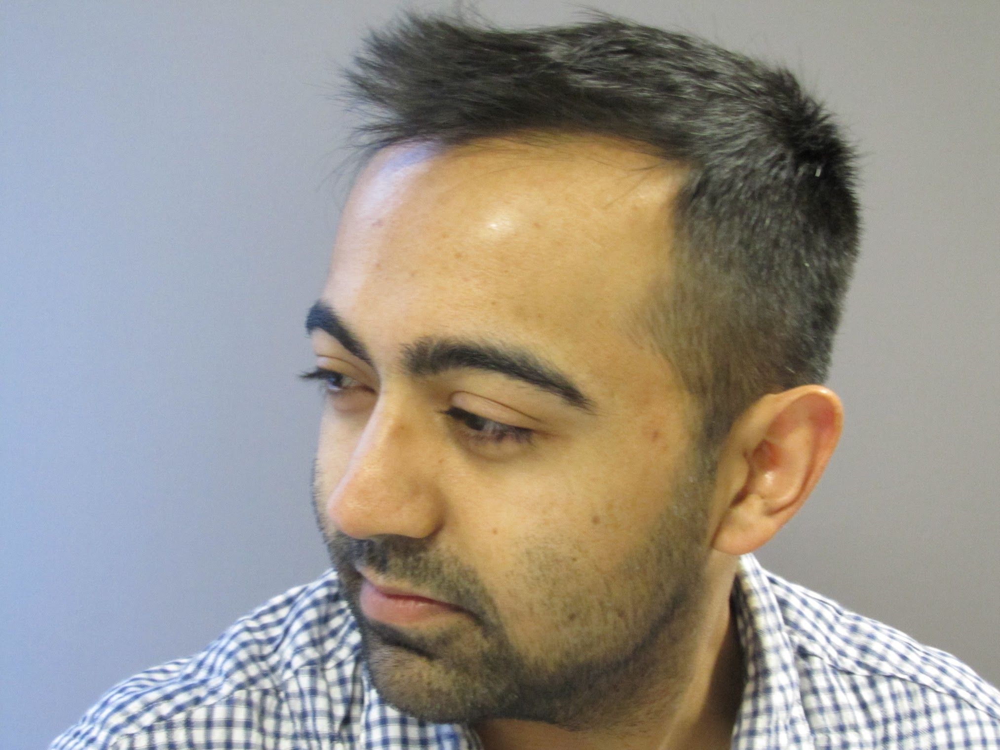 Man showing visible signs of Hair Thinning Alopecia along the hairline and temples, illustrating early-stage thinning and reduced hair density.