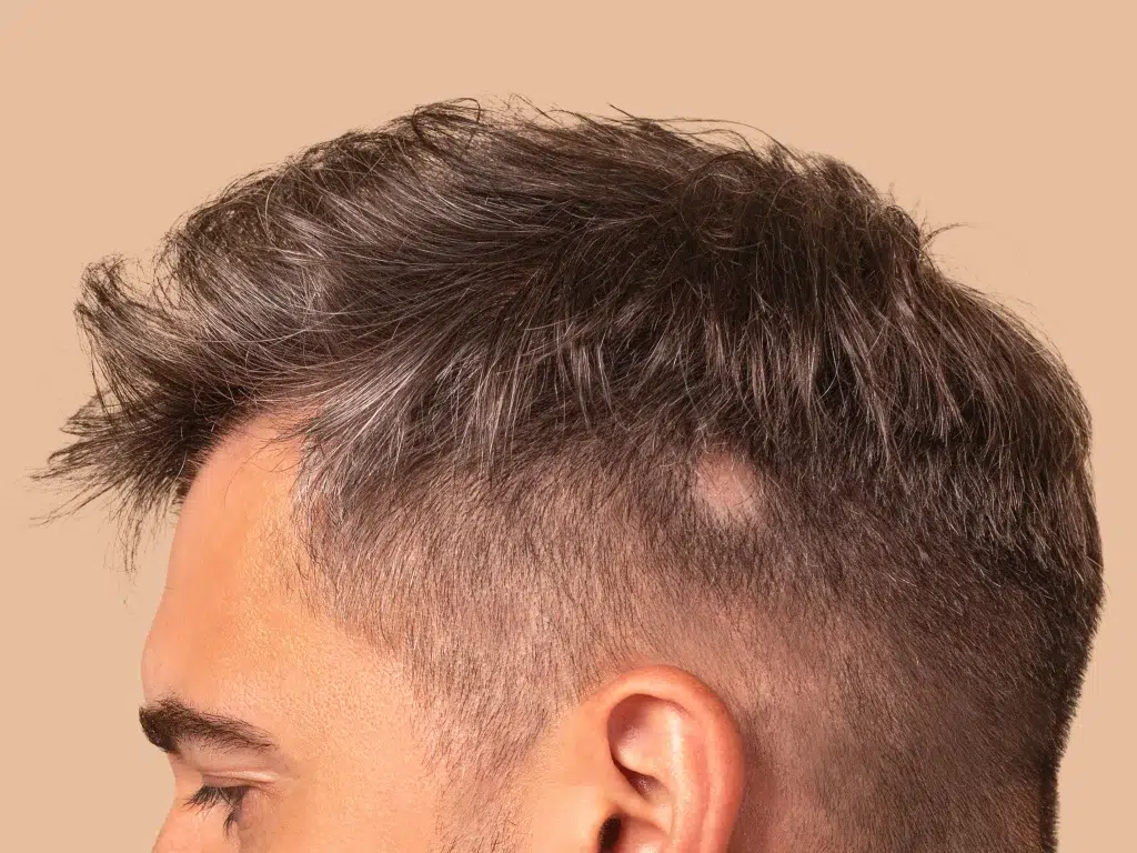 What is Alopecia Awareness Month