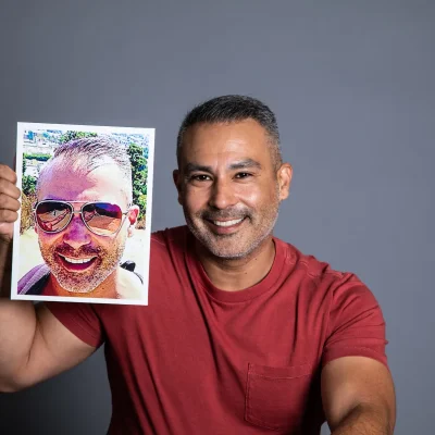 Eyeing Turkey for Your Hair Transplant? Here&rsquo;s Why U.S. Expertise Wins Every Time