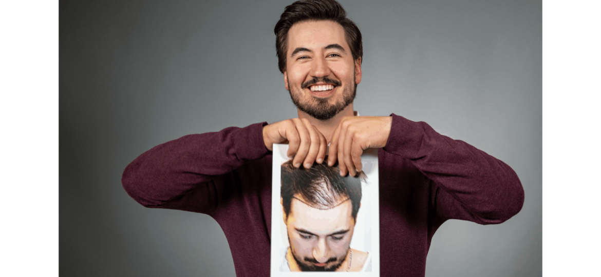 Hair baldness in men showing thinning hair and receding hairline before treatment