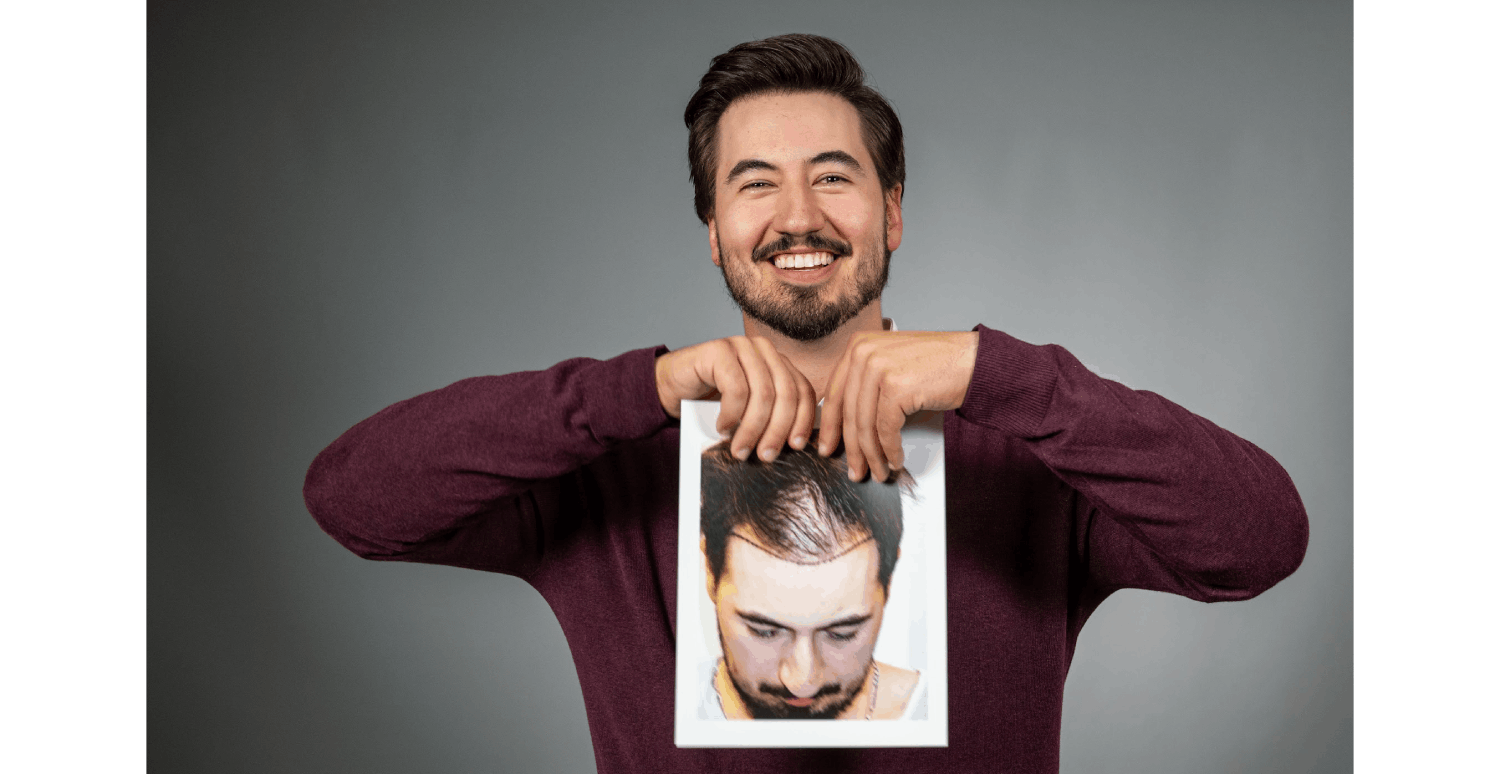 Hair baldness in men showing thinning hair and receding hairline before treatment