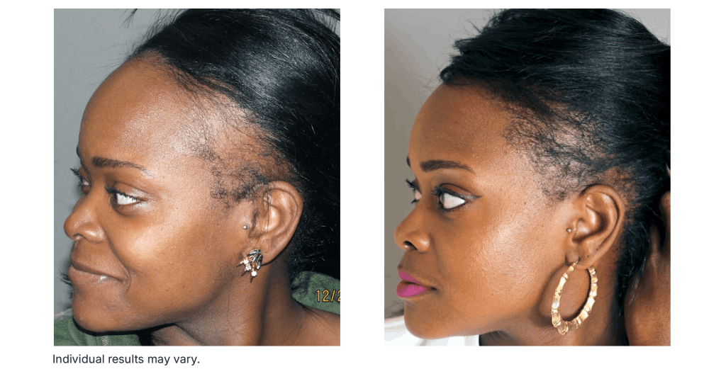 Traction alopecia causing hairline thinning along the temples due to repeated tension from tight hairstyles